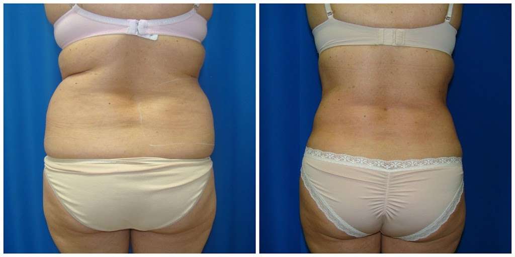 Houston Liposuction Center | 1941 W T C Jester Blvd #102, Houston, TX 77008, USA | Phone: (713) 777-5476