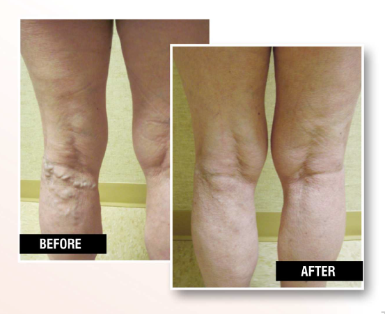 USA Vein Clinics | 1208B VFW Pkwy #300, West Roxbury, MA 02132, USA | Phone: (617) 391-6900