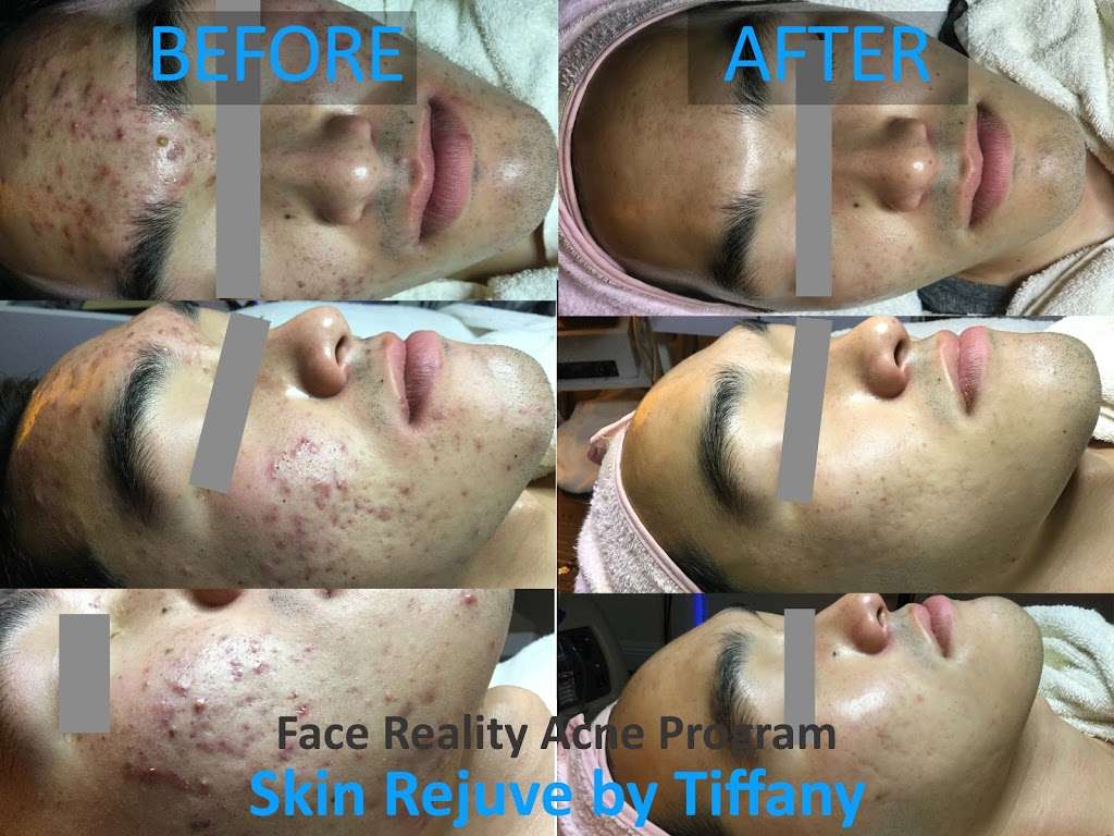 Skin Rejuve by Tiffany | 340 Magnet, Irvine, CA 92618, USA | Phone: (323) 346-9393