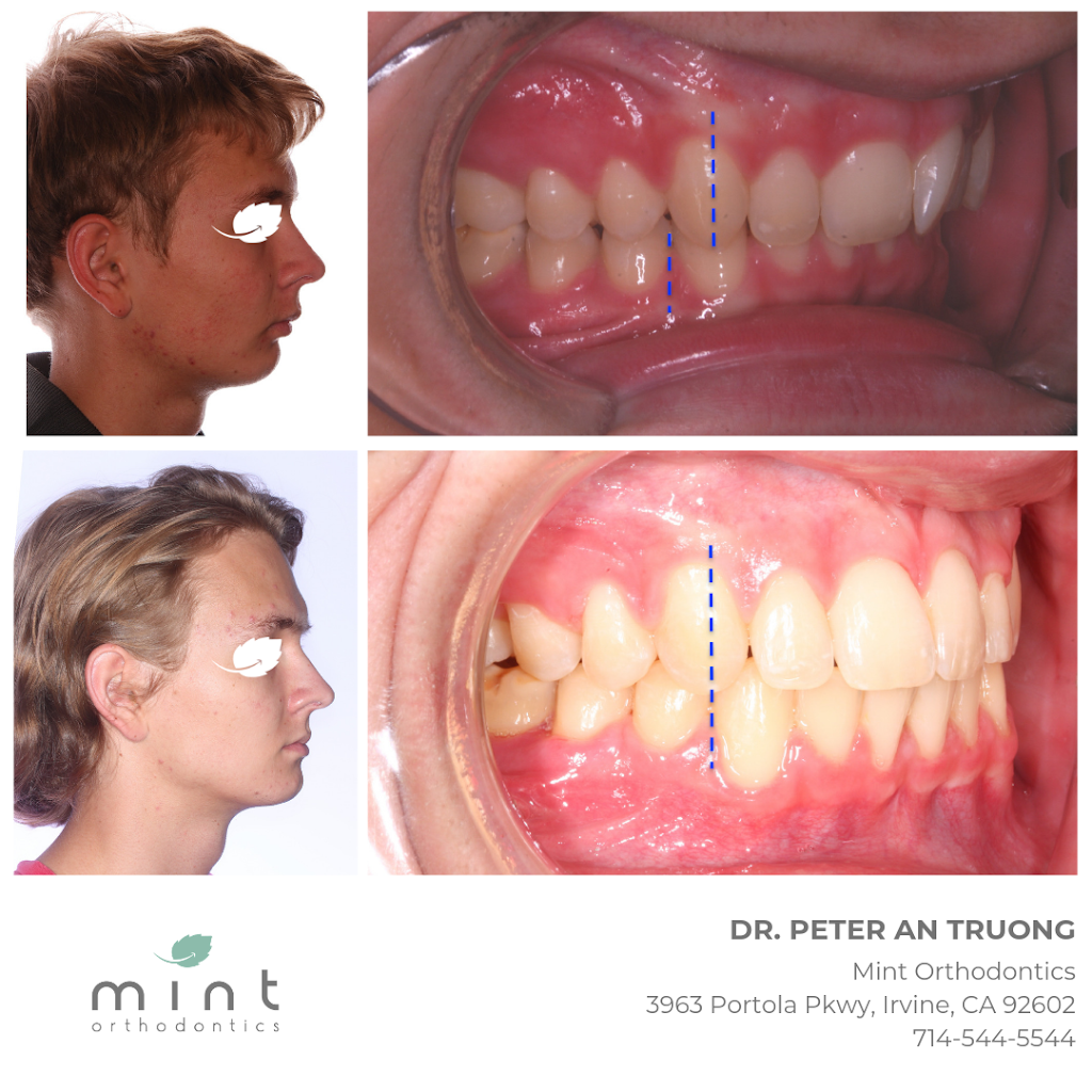 Mint Orthodontics | 3963 Portola Pkwy, Irvine, CA 92602, USA | Phone: (714) 544-5544