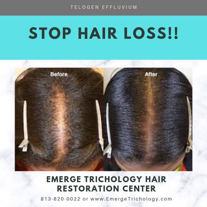 Emerge Hair Restoration | 7403 Temple Terrace Hwy suite a, Temple Terrace, FL 33637, USA | Phone: (813) 820-0022