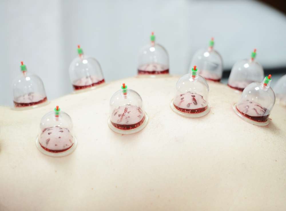 Hijama in North London | 13 Streamside Cl, London N9 9XB, UK | Phone: 07515 313518