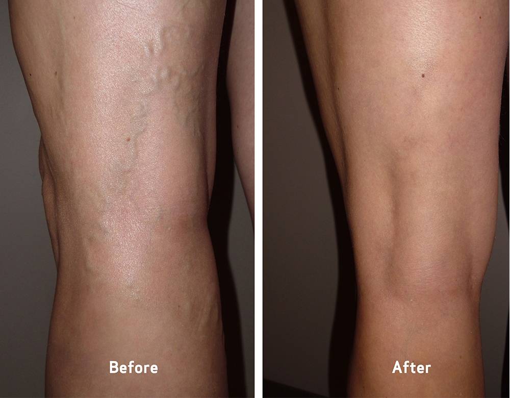Vein Clinics of America | 6149 Windhaven Pkwy Suite 130, Plano, TX 75093, USA | Phone: (972) 881-1320