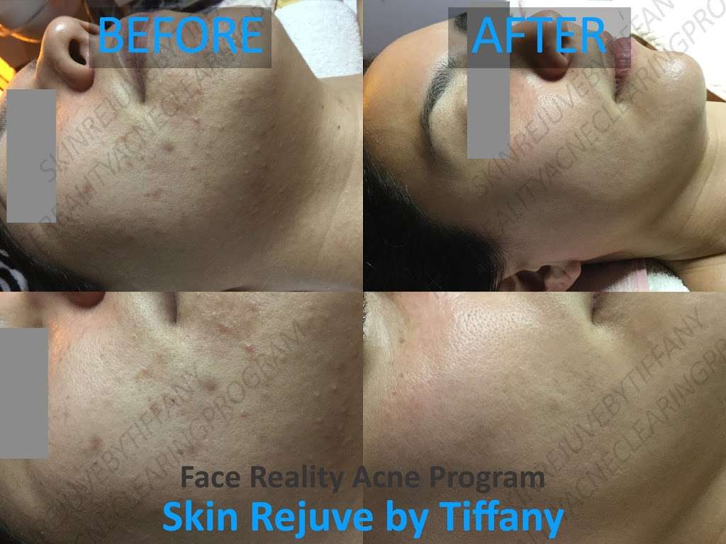 Skin Rejuve by Tiffany | 340 Magnet, Irvine, CA 92618, USA | Phone: (323) 346-9393