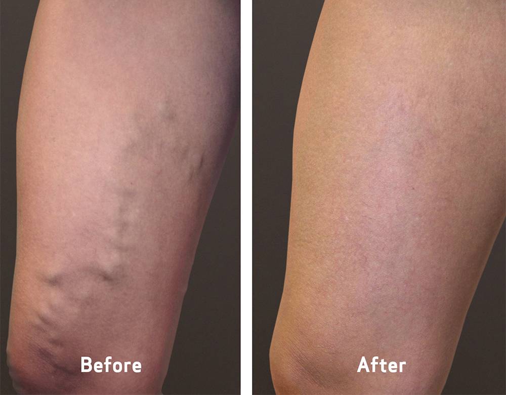 Vein Clinics of America | 6149 Windhaven Pkwy Suite 130, Plano, TX 75093, USA | Phone: (972) 881-1320