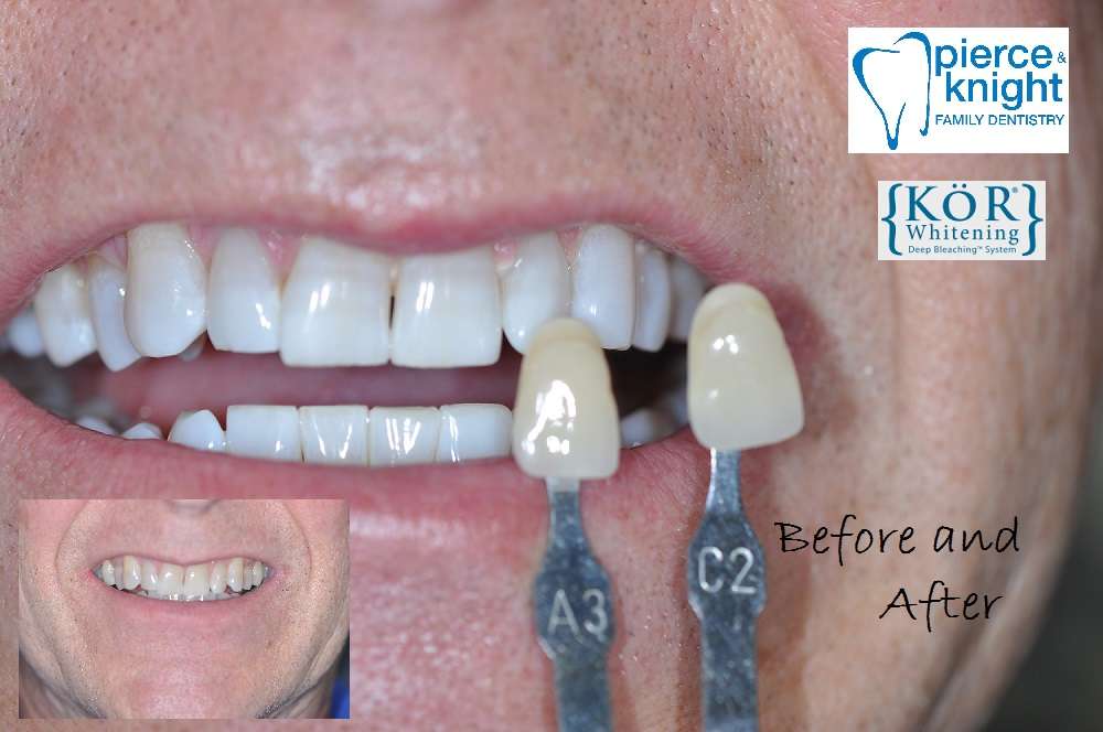 Pierce & Knight Family Dentistry | 8615 Rosehill Rd #101, Lenexa, KS 66215, USA | Phone: (913) 888-2882