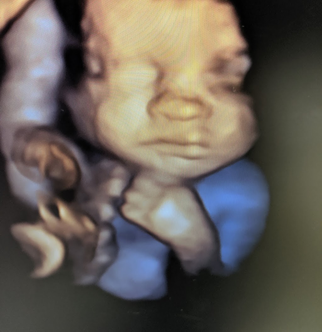 Sweet Baby Face HD 3D 4D 5D Ultrasound | 3422 Stony Spring Cir, Louisville, KY 40220, USA | Phone: (502) 509-1003