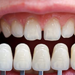 Lantern Dental | 412 E Pleasant Run Rd, DeSoto, TX 75115, USA | Phone: (972) 274-9300