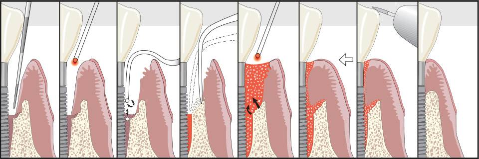 Periodontics and Dental Implants of North Carolina | 6101 Grace Park Dr, Morrisville, NC 27560, USA | Phone: (919) 493-9900