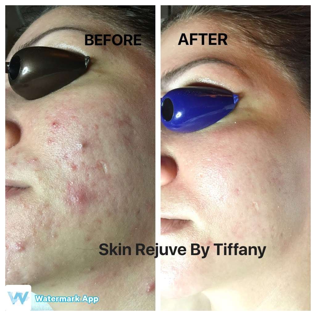 Skin Rejuve by Tiffany | 340 Magnet, Irvine, CA 92618, USA | Phone: (323) 346-9393