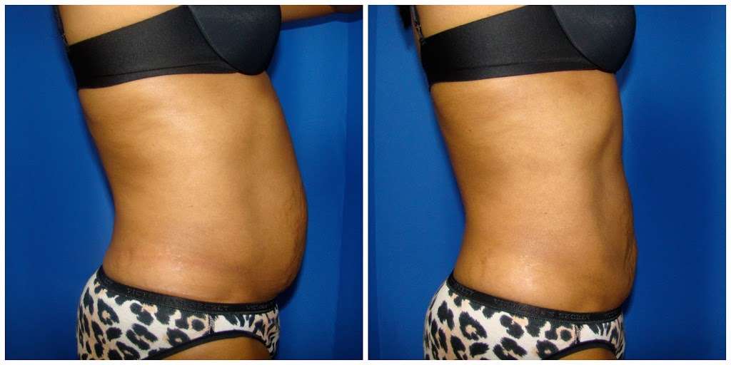 Houston Liposuction Center | 1941 W T C Jester Blvd #102, Houston, TX 77008, USA | Phone: (713) 777-5476