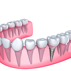 Lantern Dental | 412 E Pleasant Run Rd, DeSoto, TX 75115, USA | Phone: (972) 274-9300