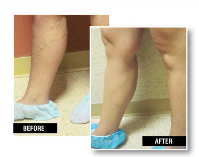 USA Vein Clinics | 333 W 89th Ave ste w-2, Merrillville, IN 46410, USA | Phone: (219) 525-1652