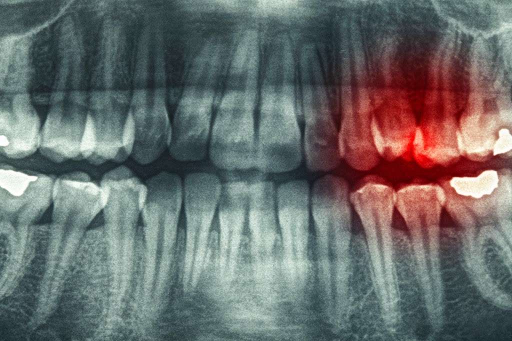 Apex Endodontics: Michael Sang Ro DDS | 1617, 446 NY-304 suite b, Bardonia, NY 10954, USA | Phone: (845) 694-3626