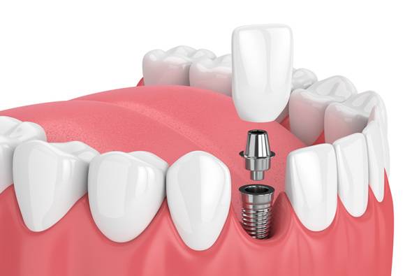 Periodontics and Dental Implants of North Carolina | 6101 Grace Park Dr, Morrisville, NC 27560, USA | Phone: (919) 493-9900